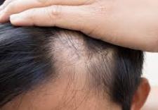 Area celsi - alopecia aerata